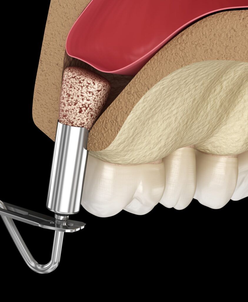 Sinus Lift Surgery - Adding new bone. 3D illustration