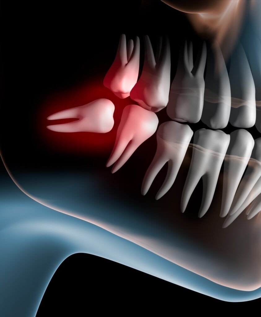 Pain caused by wisdom teeth - 3D illustration