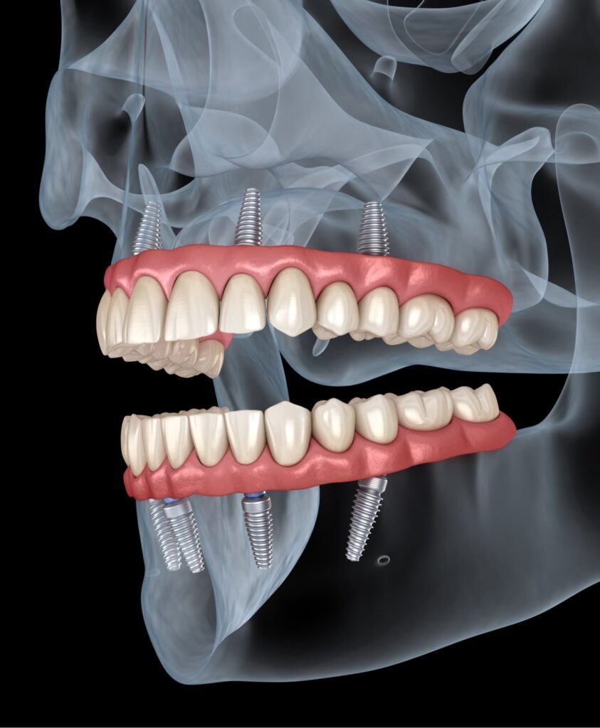 Upper and lower prosthesis with gum