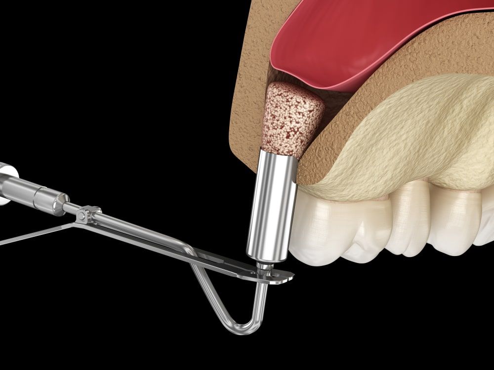 Sinus Lift Surgery - Adding new bone. 3D illustration