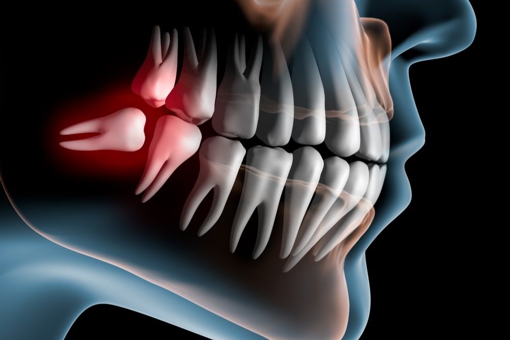 Pain caused by wisdom teeth - 3D illustration