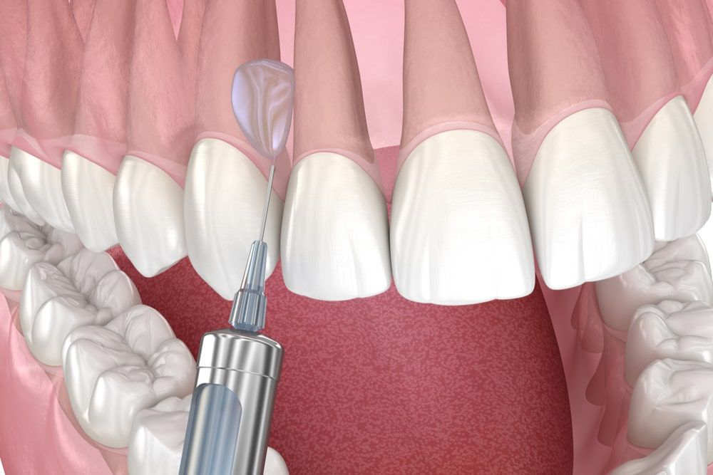 Local Dental anesthesia. 3D illustration of dental treatment