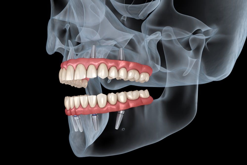 Upper and lower prosthesis with gum