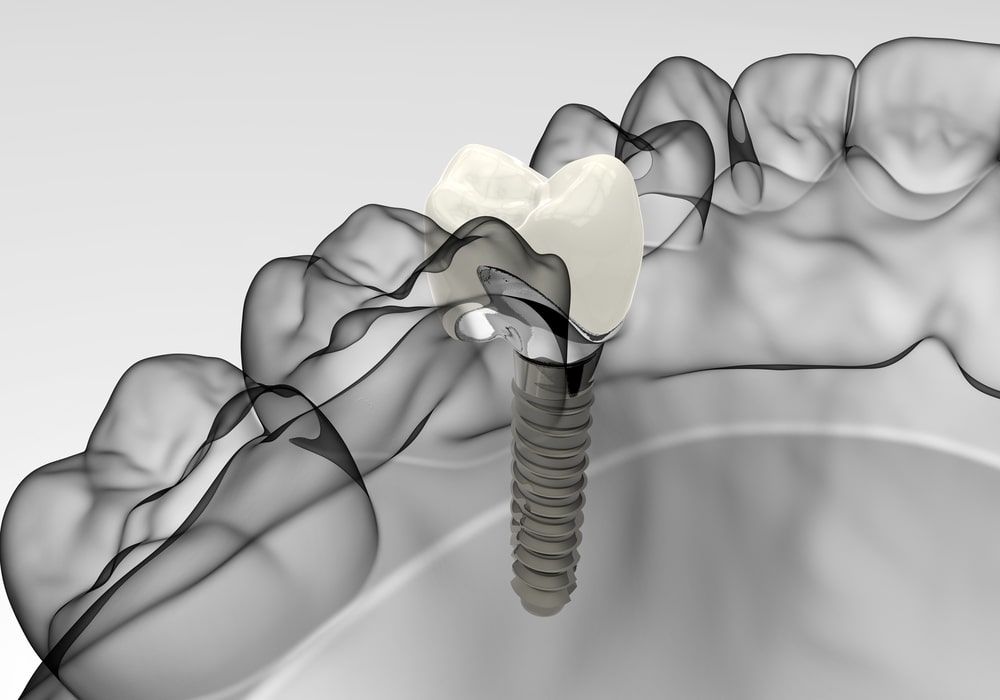 3D rendering implant model jaw