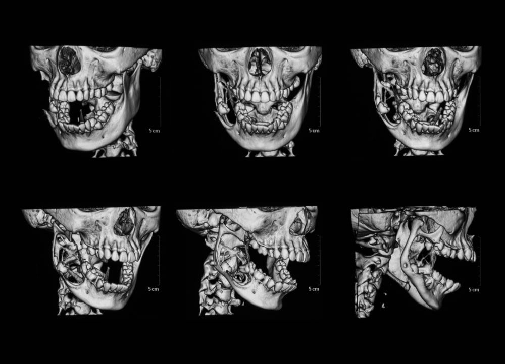 3D MRI (Three dimension magnetic resonance imaging of face