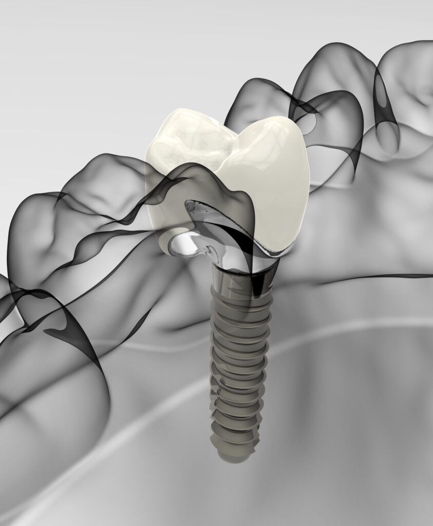 3D rendering implant model jaw