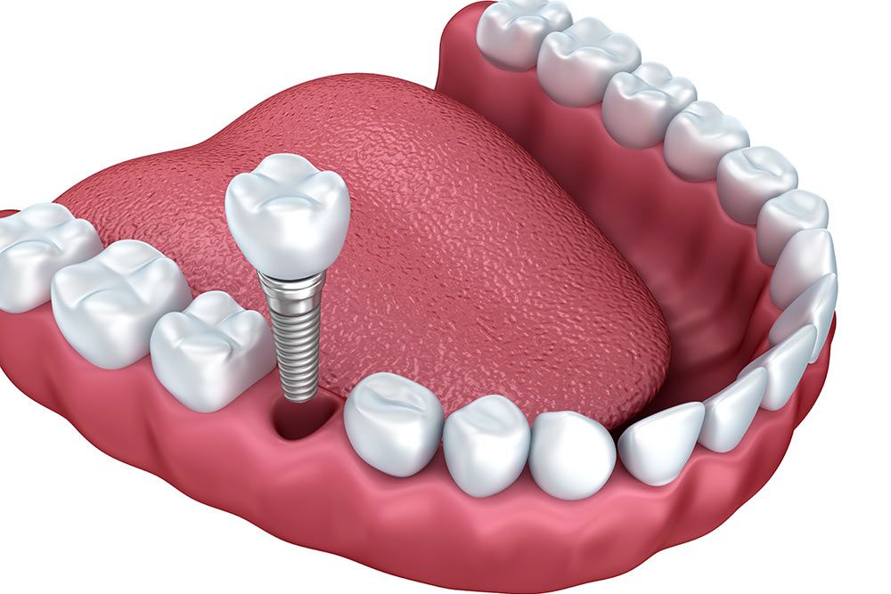 Dental Implant 3D image