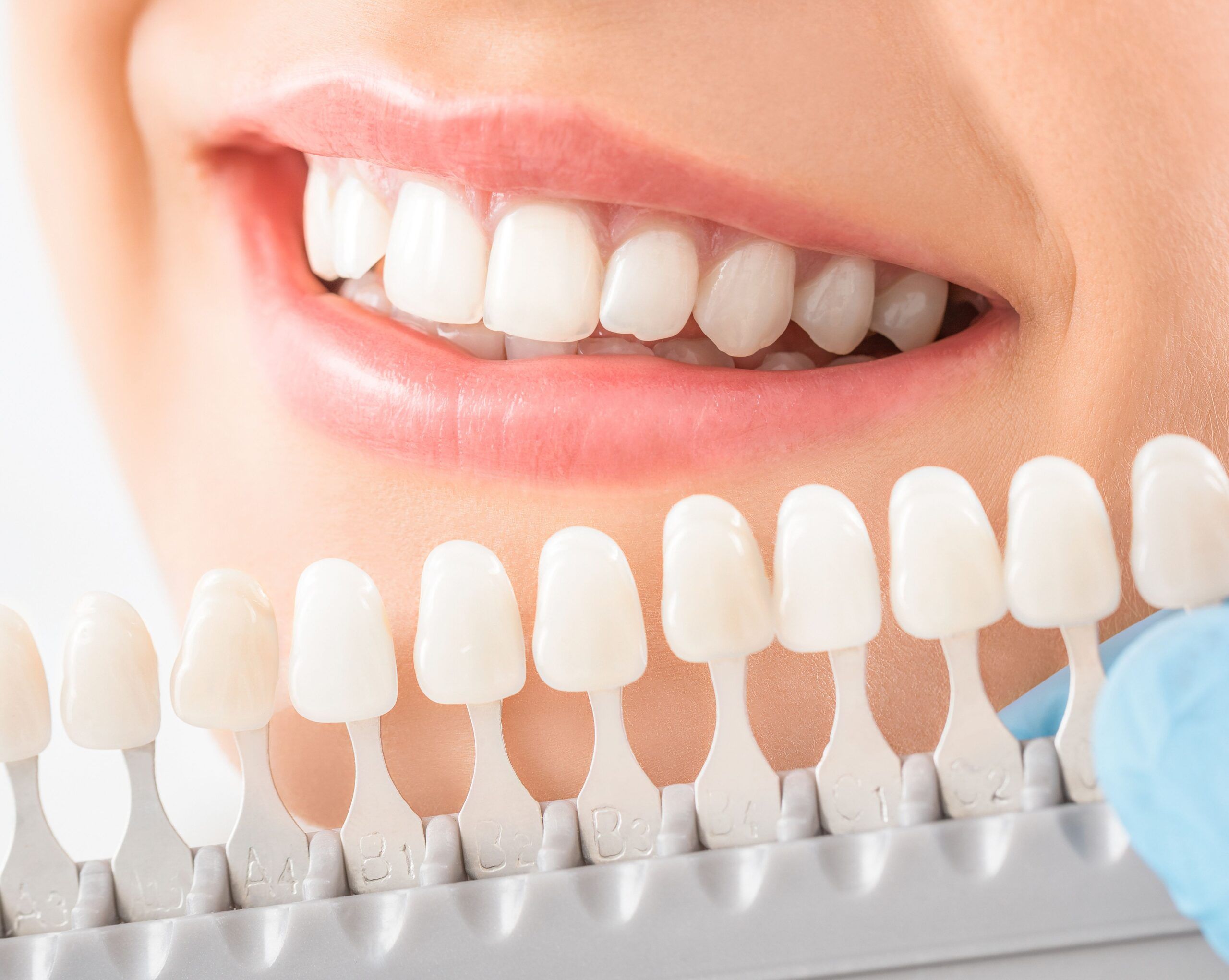 Teeth Whitening in Fort Myers, FL