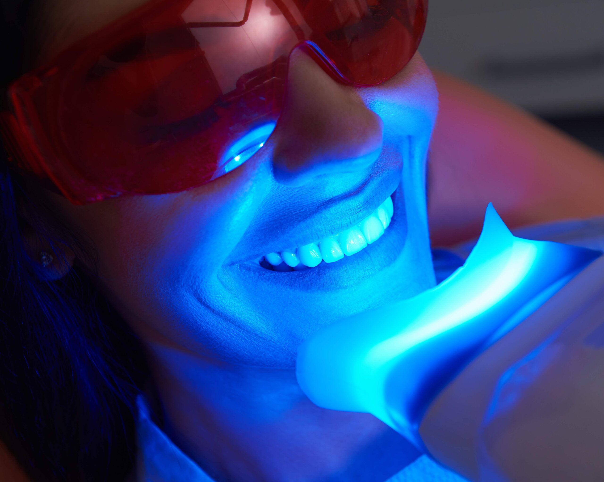 Professional Teeth Whitening in Fort Myers, FL