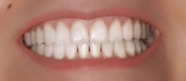 Cosmetic Dentistry After Treatment