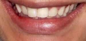 Cosmetic Dentistry Before Treatment