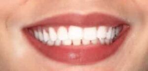 Cosmetic Dentistry After Treatment