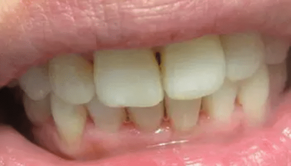Invisalign After Treatment