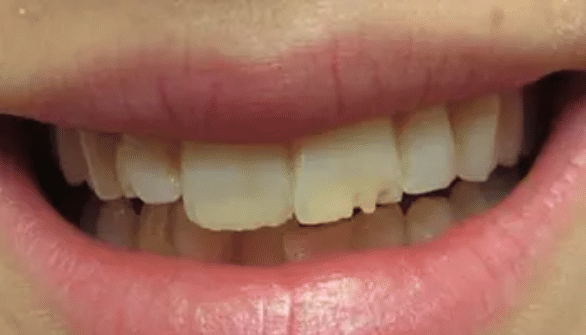 Smile Makeover Before Treatment