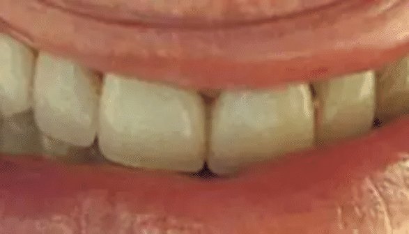 Full Mouth Reconstruction After Treatment