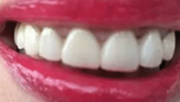 Full Mouth Reconstruction After Treatment