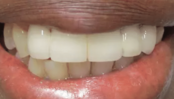 Smile Makeover After Treatment