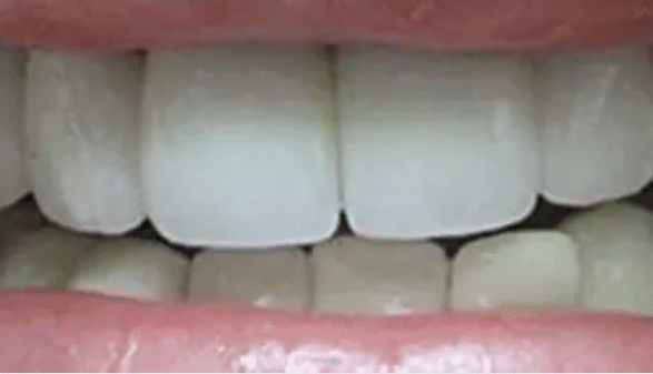 Smile Makeover After Treatment