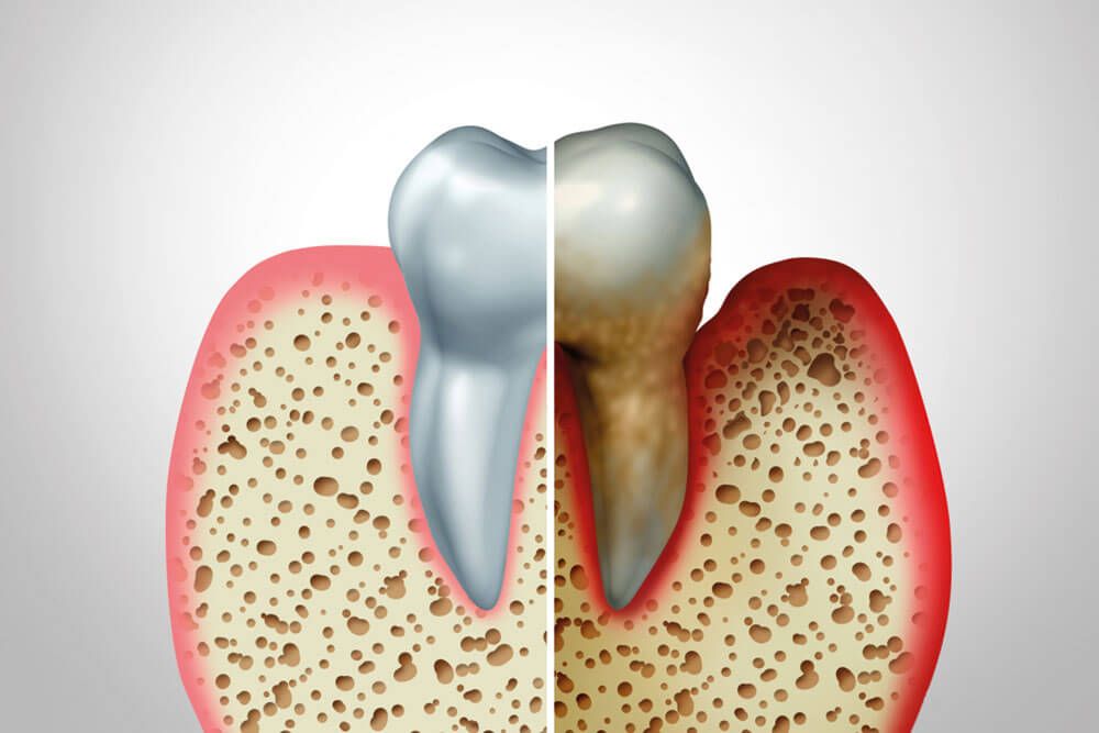 Gum disease with a healthy and unhealthy tooth