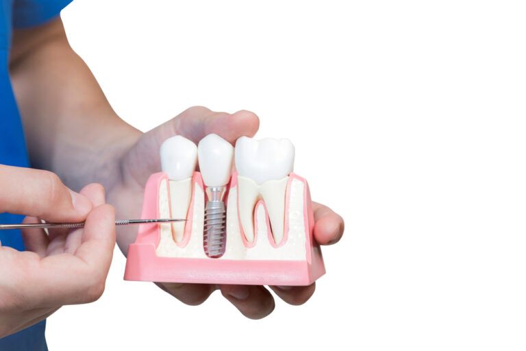 Dentist hold a breadboard model of the tooth with an implant