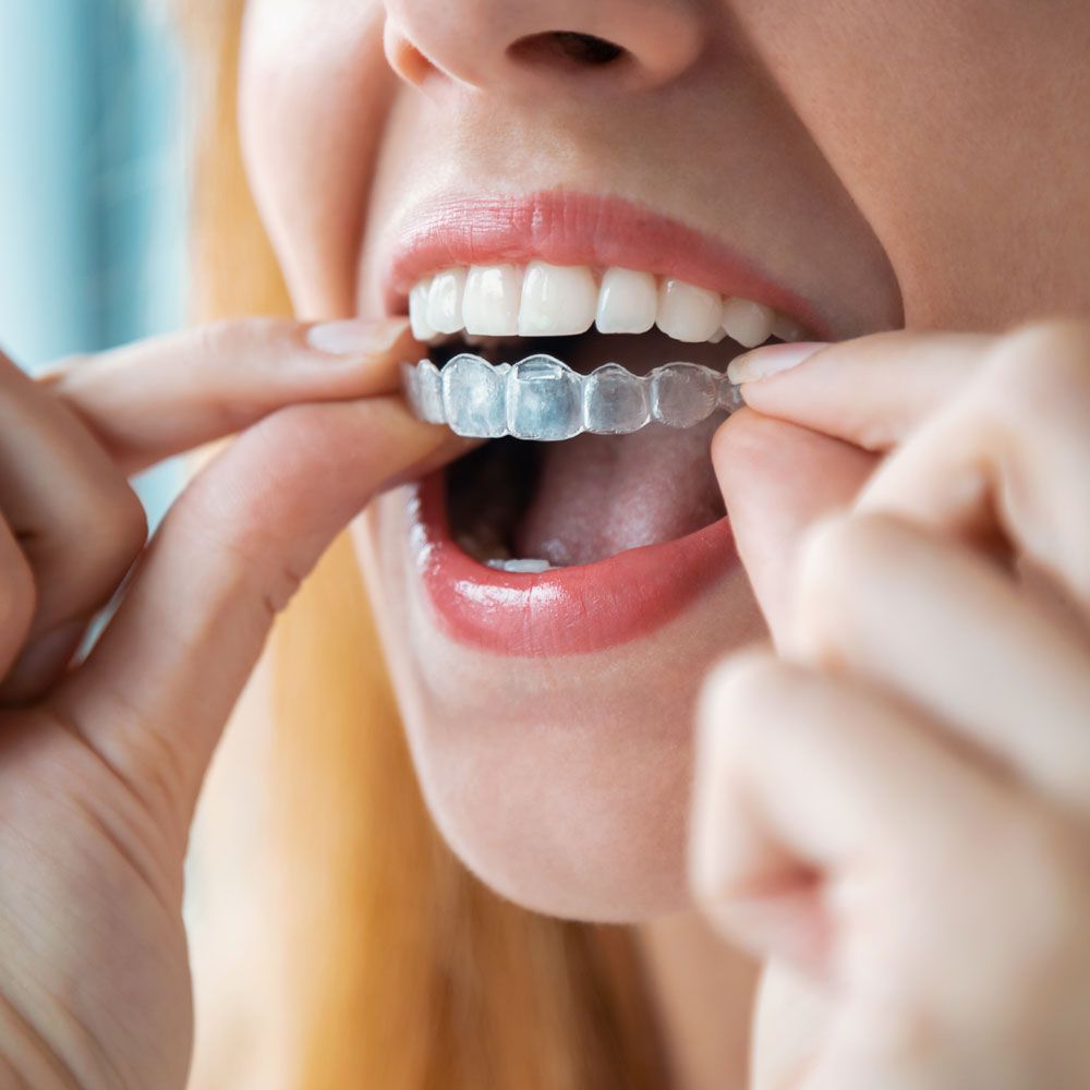 woman wearing orthodontic silicone trainer