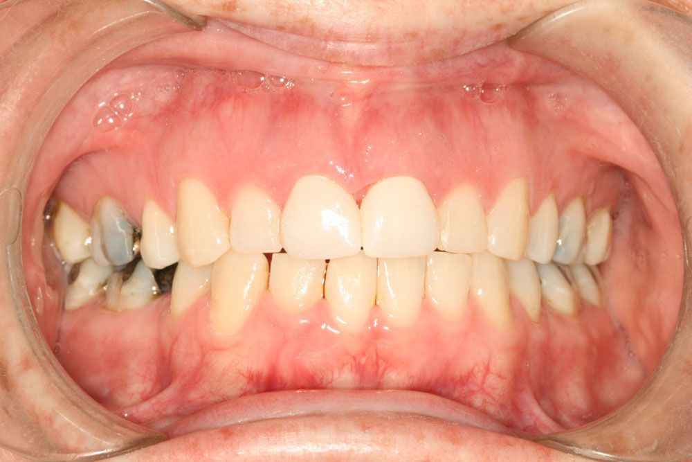 After treatment image