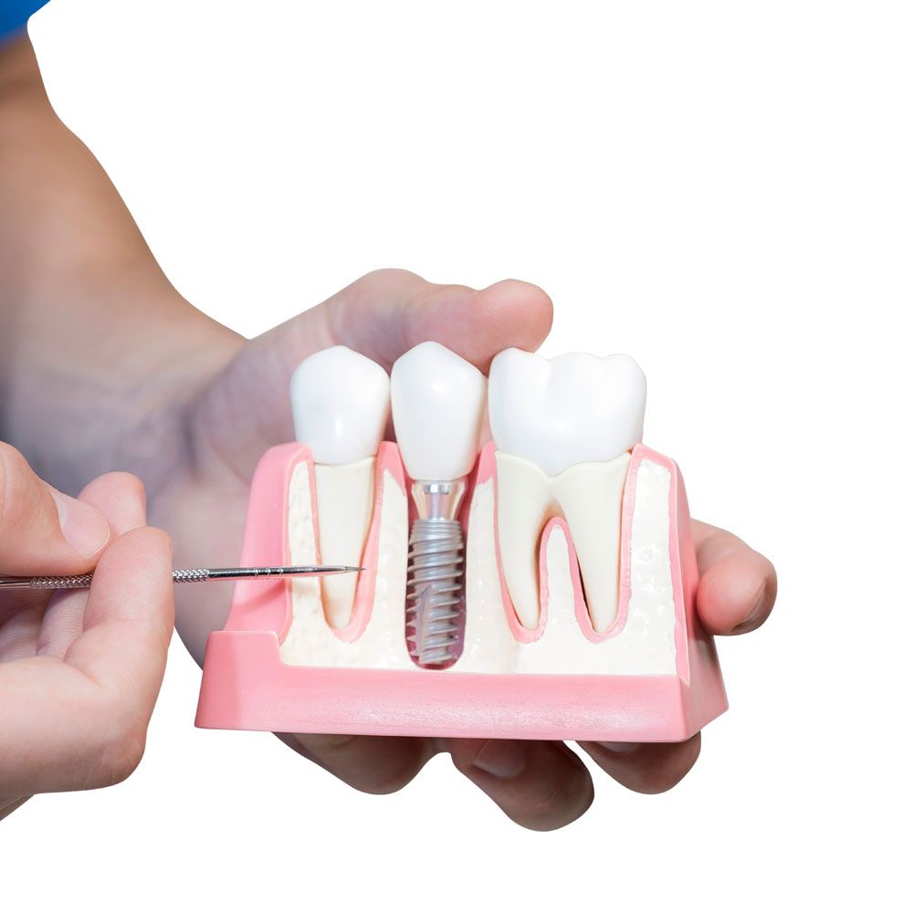 Dentist hold a breadboard model of the tooth with an implant