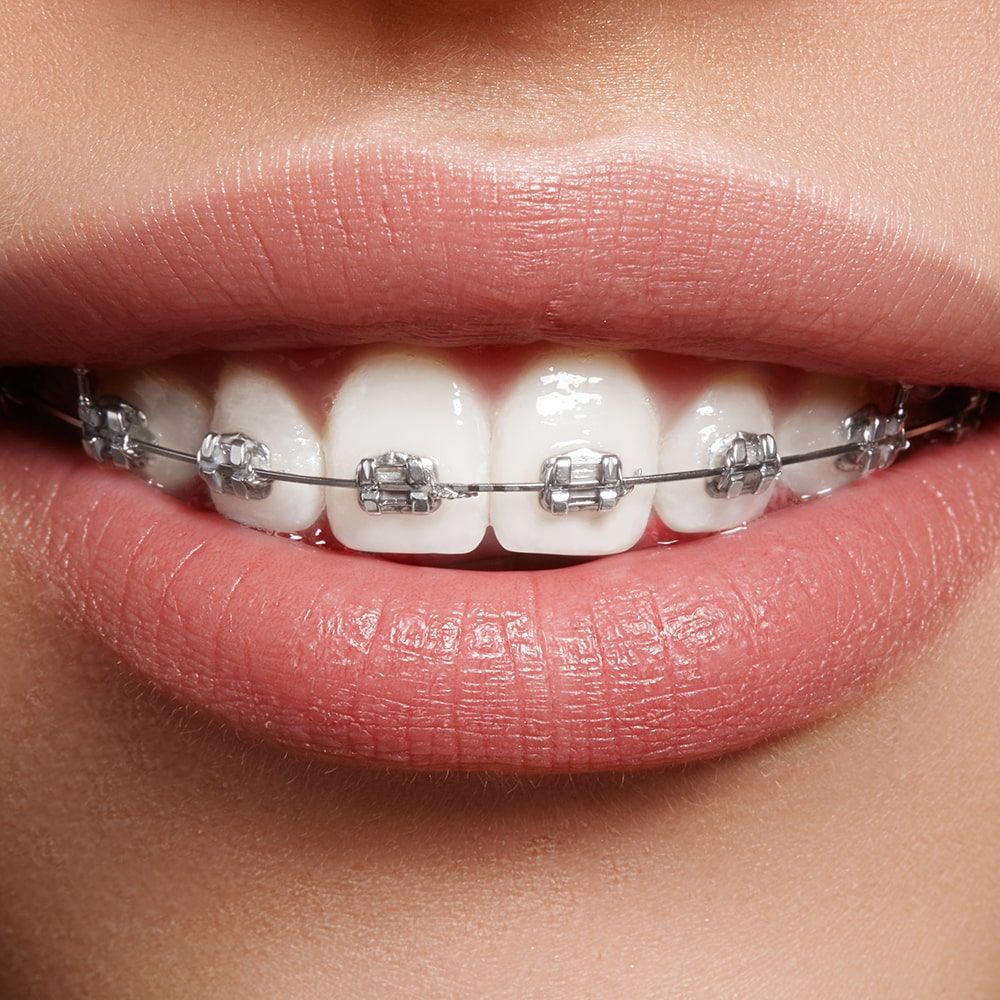 Beauty woman smile with braces