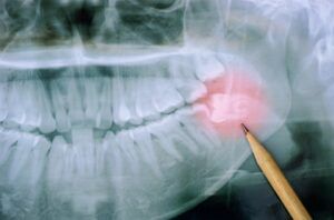 Panoramic x-ray image of teeth