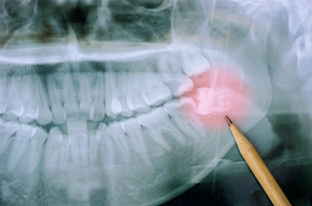 Panoramic x-ray image of teeth