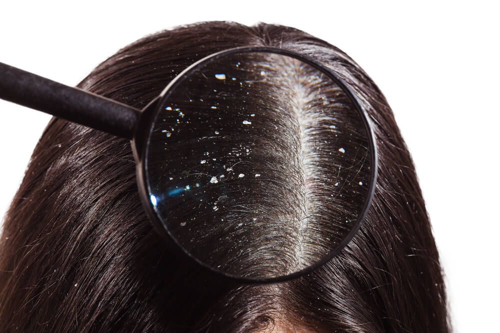 A magnifying glass at the dandruff on dark female hair
