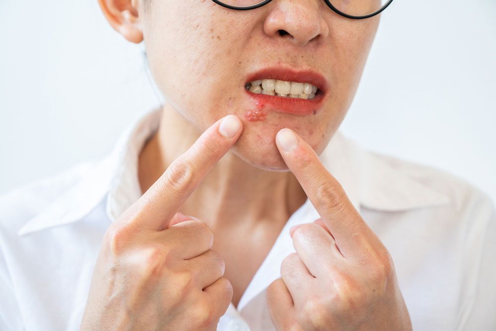 Woman pointing to Herpes labialis on her lower lip