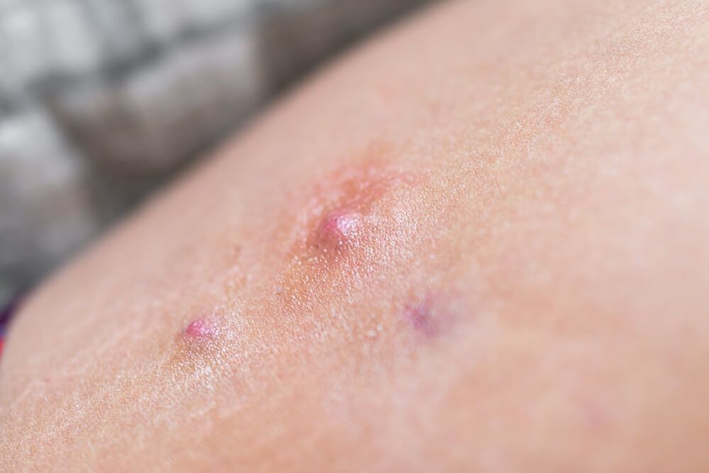 Macro closeup of red swollen boil pimple on leg skin