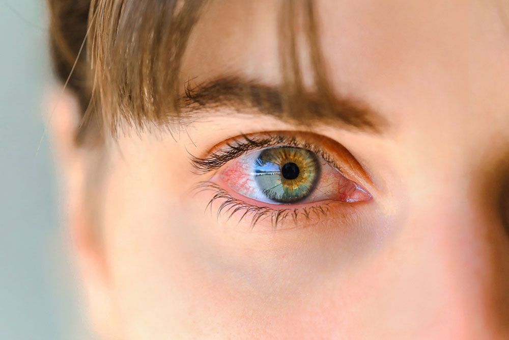 Green eyes of a teenager inflamed and with red veins