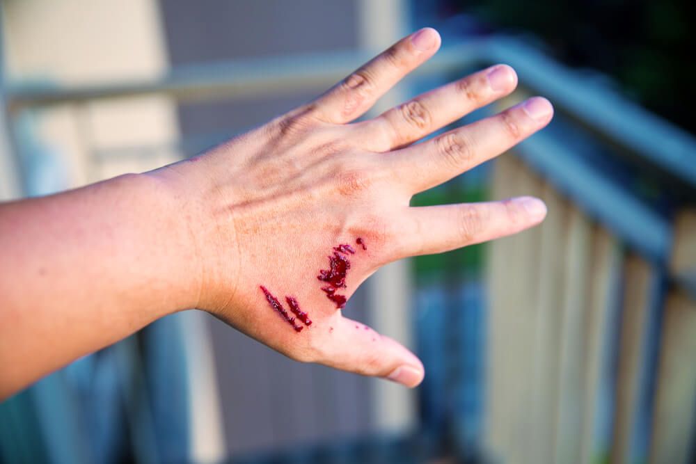 Dog bite wound and blood on hand
