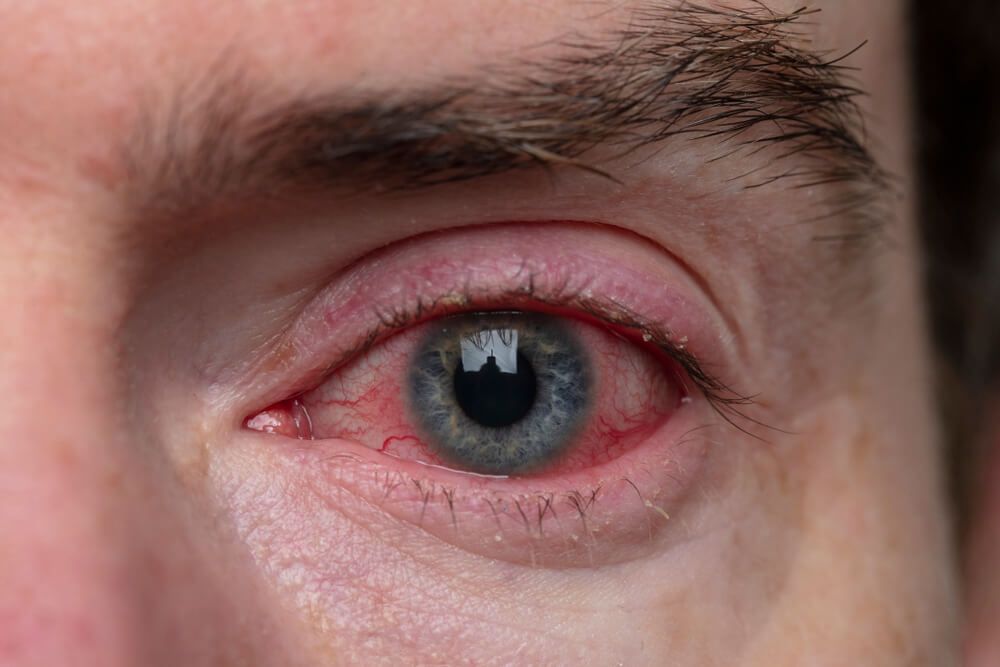 a severe bloodshot eye