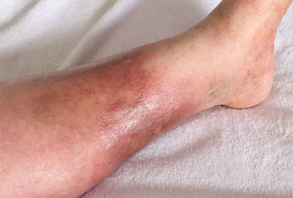 A woman's leg, she is suffering from Chronic Venous Insufficiency with mild cellulitis