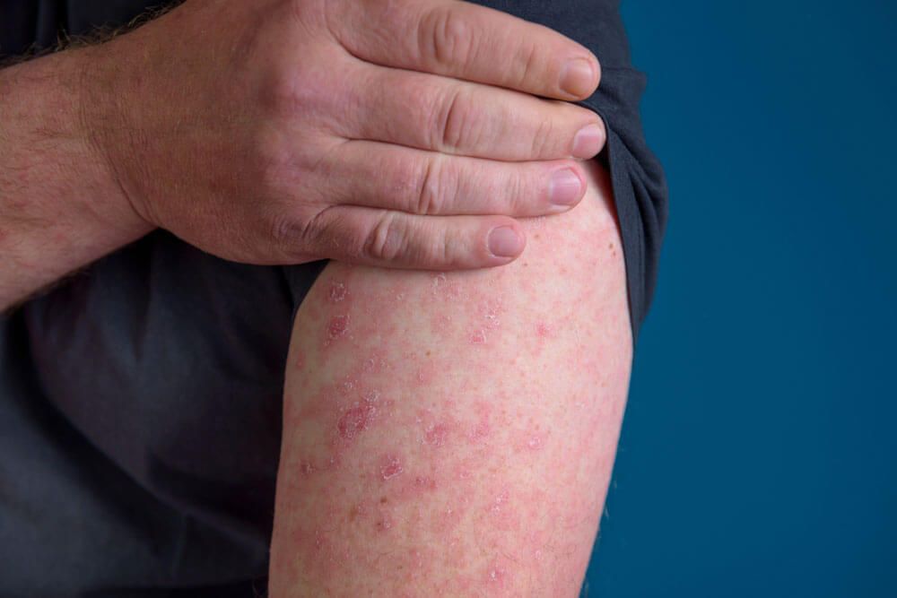 Cellulitis telehealth tmd