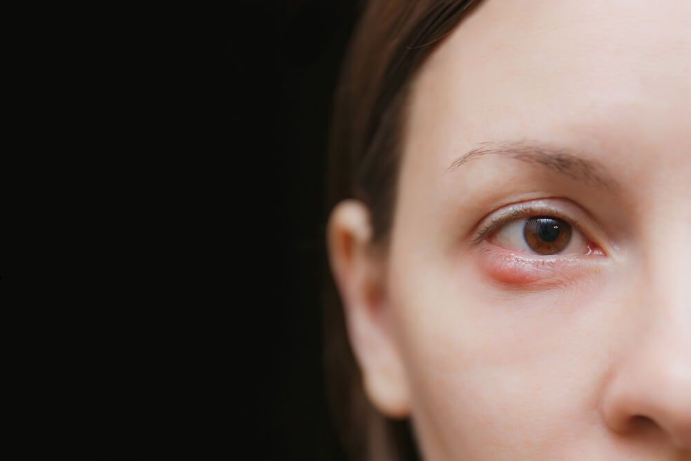 young woman barley brown one eye infection
