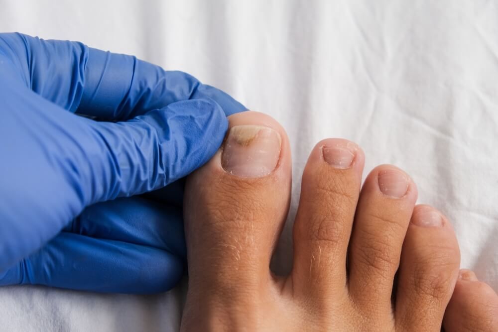 A doctor examines bare foot with onycholysis on a toenail
