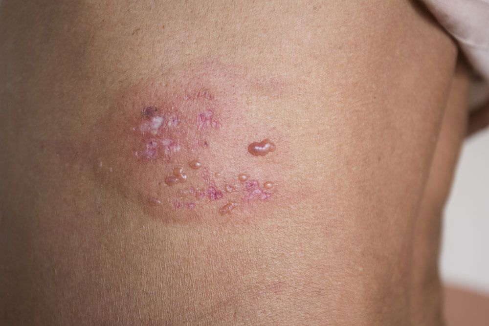 Detail of skin with Herpes Zoster (Shingles)