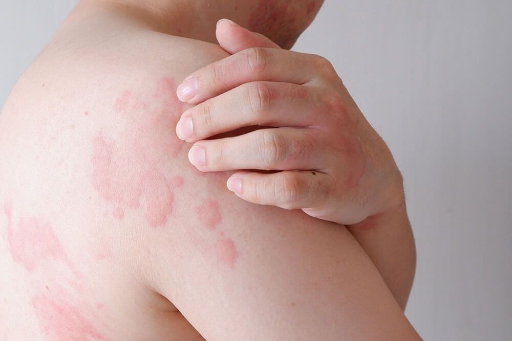 skin suffering severe urticaria or hives or kaligata
