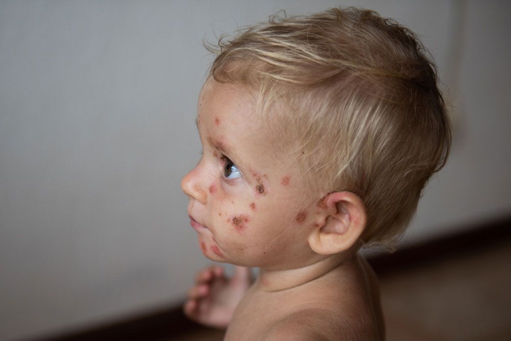 Little baby with rash on the skin of the face