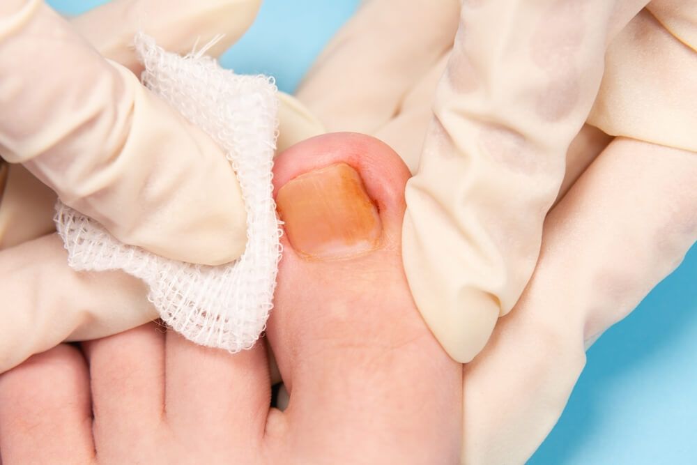 Hands in rubber gloves touch injured toenail in clinic