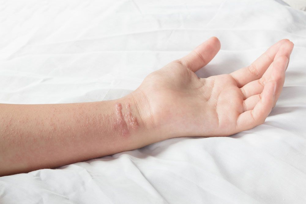 girl arm with Poison ivy rash