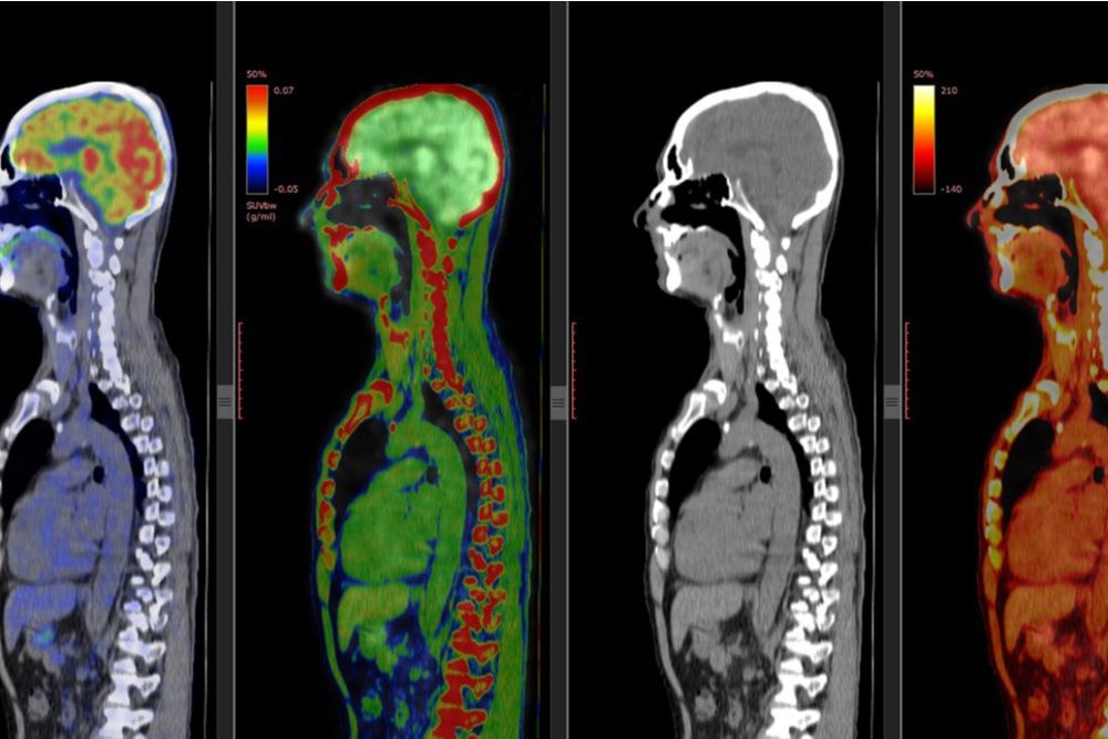 PET CT scan of Human Brain (Positron Emission Tomography)