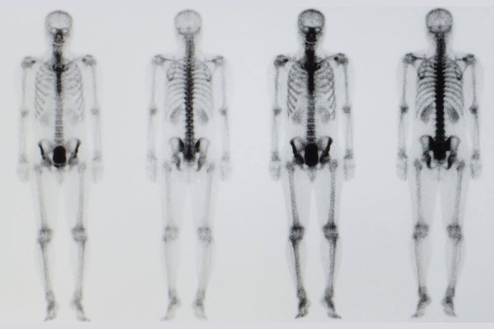 A bone scan or nuclear scan image