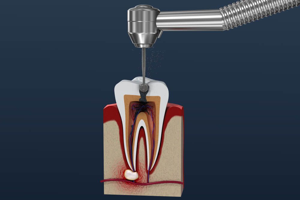 Root canal treatment process. 3D illustration