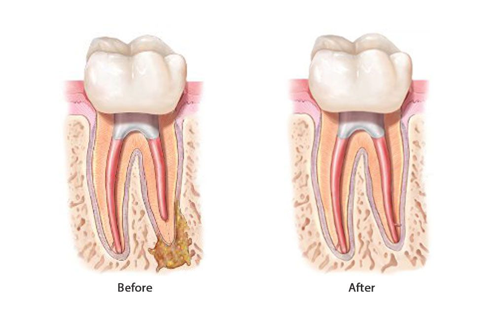 Endodontic Retreatment Before After image