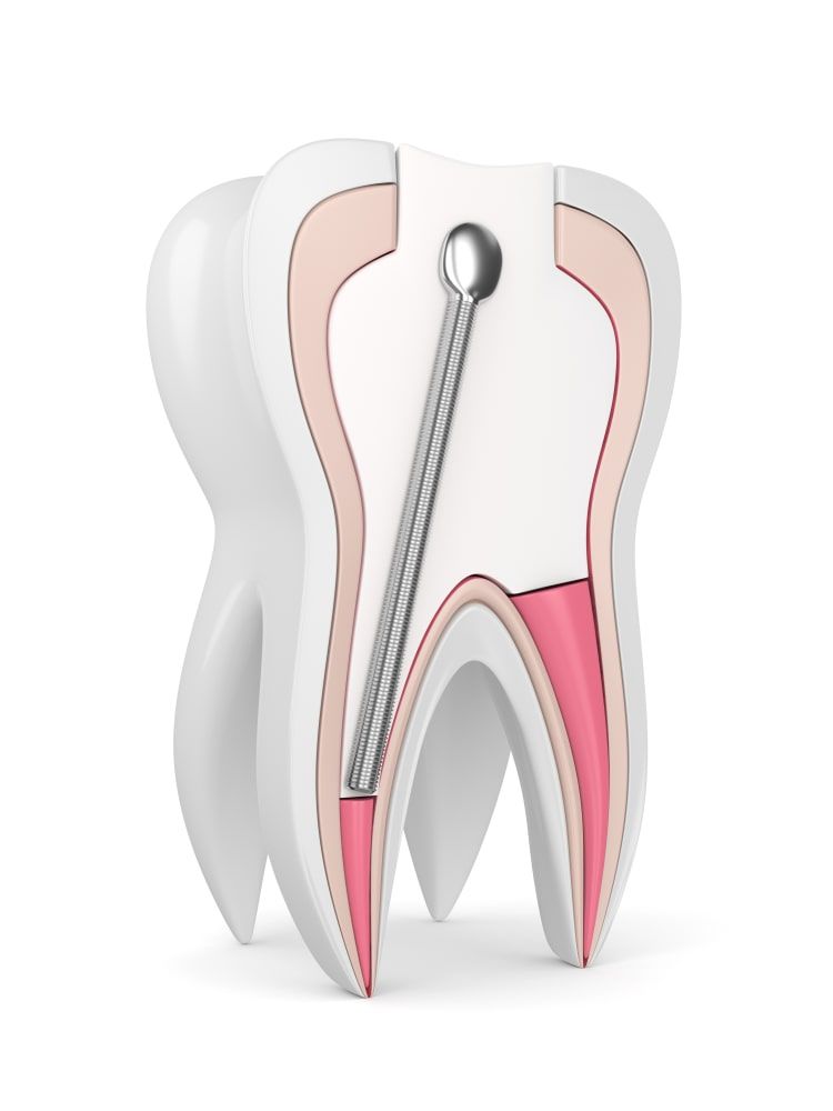 3d render of tooth with stainless steel